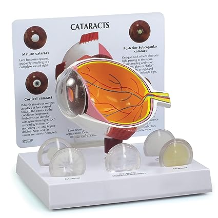 [EA-01] ESQUEMA DE OJO CATARATAS